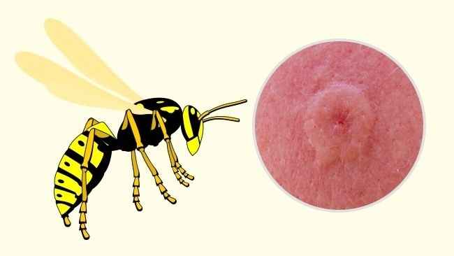 درمان نیش حشرات با عسل